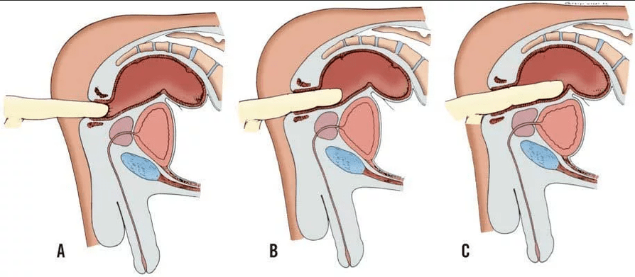 Rectal finger test